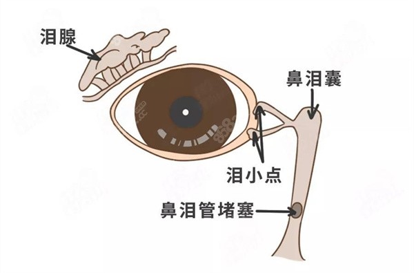 YAG激光治疗泪道疾病的适应症
