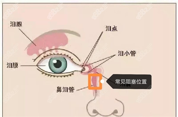 YAG激光治疗泪道疾病的原理