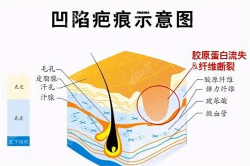 凹陷疤痕示意图