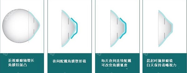 角膜塑形镜