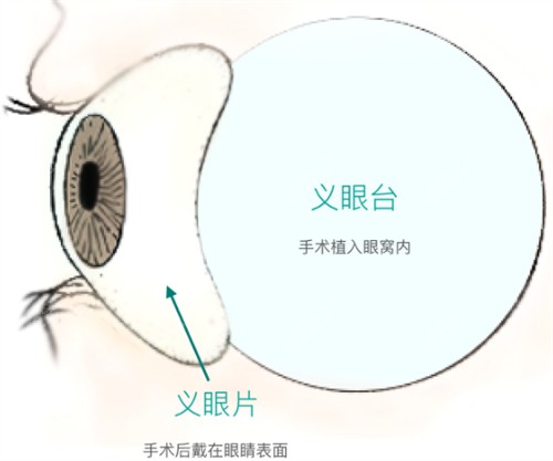 义眼手术过程图解