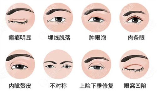 哈尔滨双燕做双眼皮修复可牛了