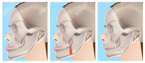 正颌手术过程图