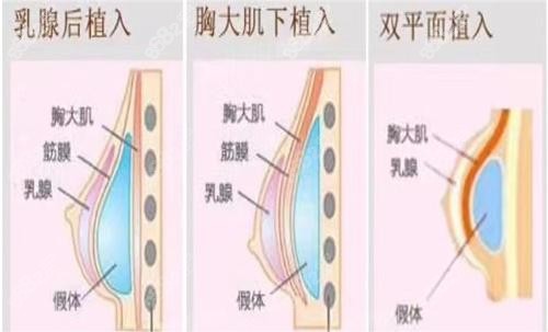 唐毅医生隆胸技艺高超