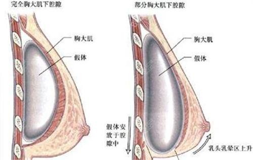 唐毅医生隆胸技艺高超