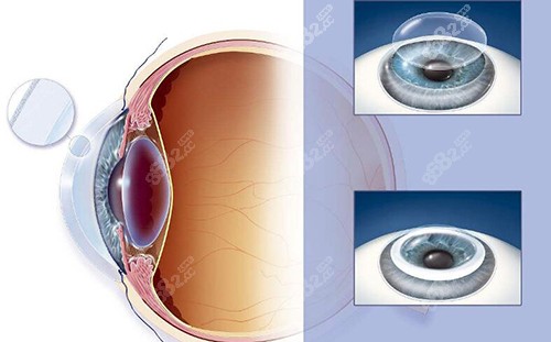 角膜移植改善展示图