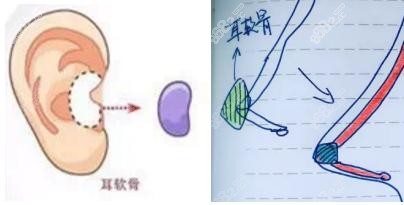 耳软骨隆鼻示意图