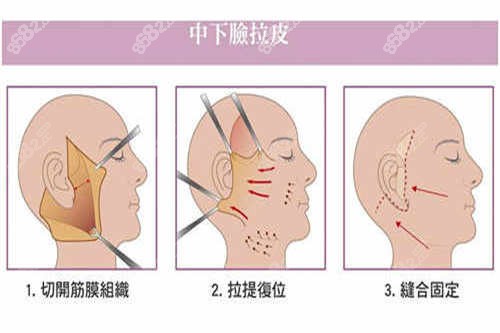 拉皮过程图