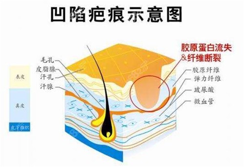 凹陷性疤痕动画图示