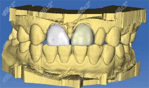 牙齿治疗数字化模拟图