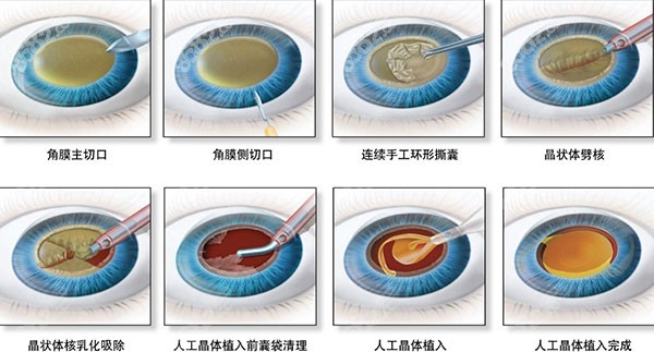 白内障超声乳化是什么意思