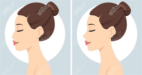 王旭明做鼻子价格贵吗？