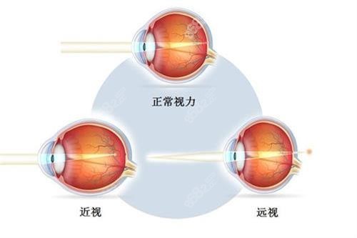 近视眼正常眼示意图