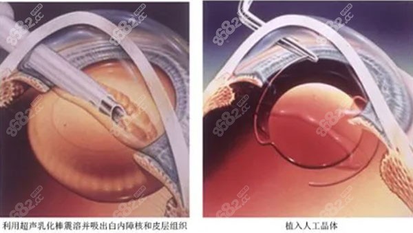 白内障超声乳化是什么意思