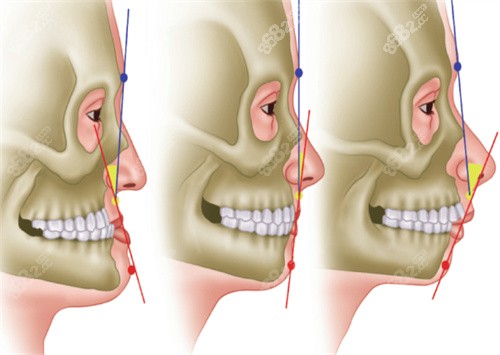 正颌手术过程图