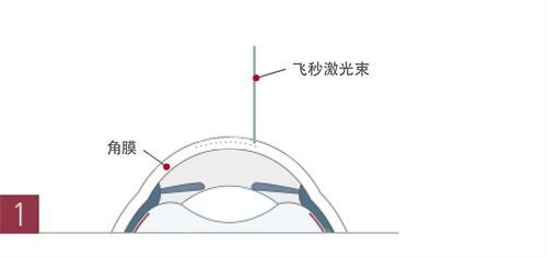 激光手术示意图