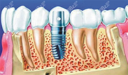 种植牙动画图