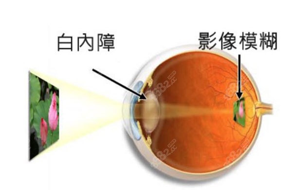 白内障的10个症状