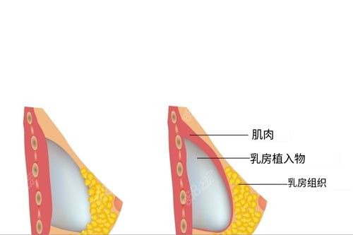 假体植入隆胸图