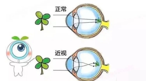 正常眼和近视眼示意图