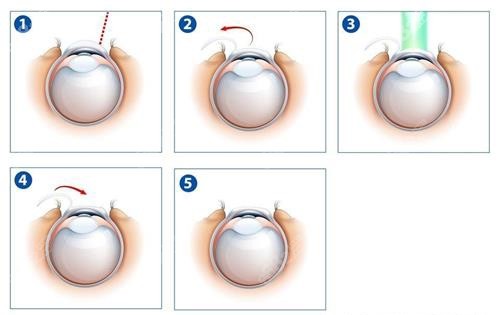 激光近视眼手术示意图