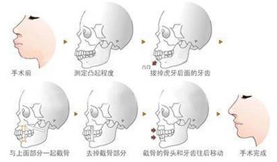 双鄂手术过程示意图