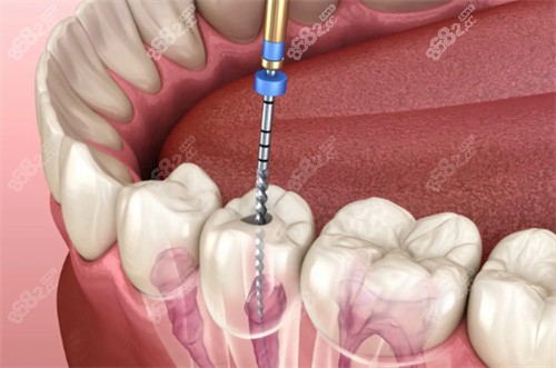 正在进行根管治疗的牙齿