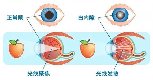 正常眼和白内障示意图