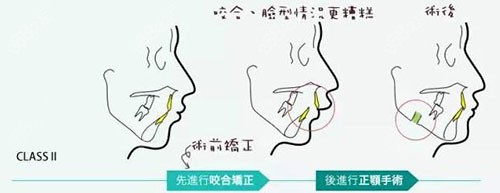 双鄂手术及正畸过程示意图