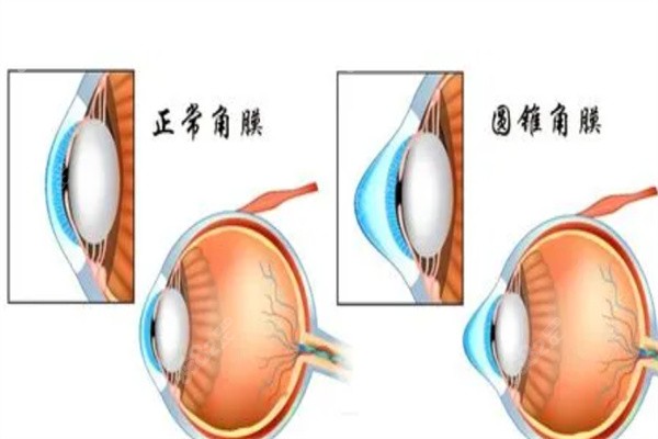 圆锥角膜怎么治疗