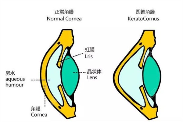什么是圆锥角膜