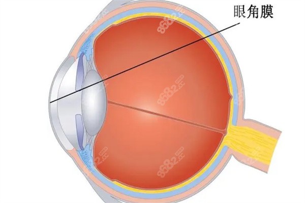 圆锥角膜眼球