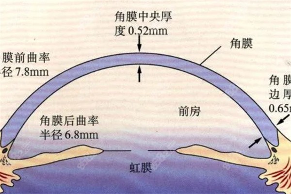 圆锥角膜厚度异常