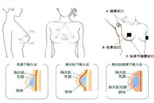 隆胸手术 过程图