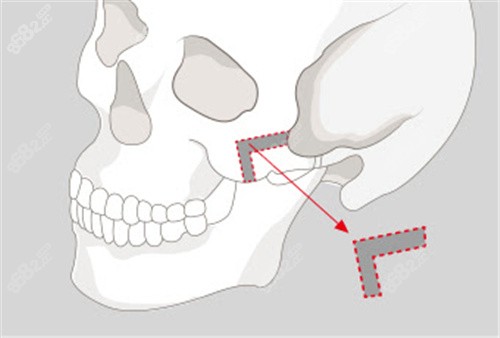 L型截骨的颧骨内推方式
