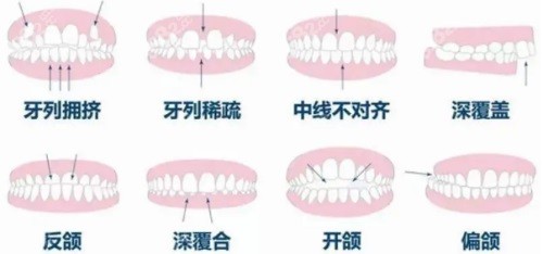 各种畸形牙齿示意图