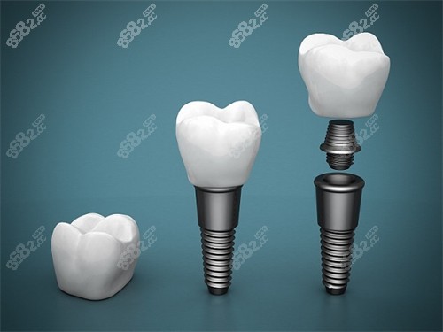 种植牙组成部分