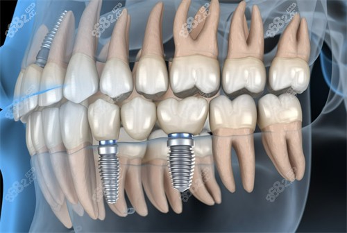 种植牙示意图