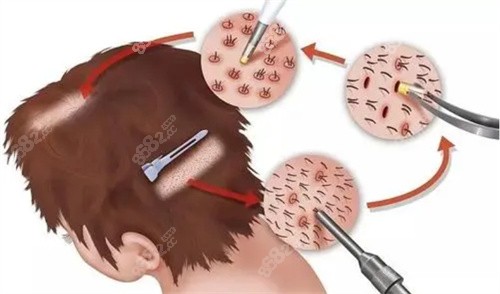 毛發(fā)移植手術(shù)動畫圖 毛發(fā)移植手術(shù)動畫圖