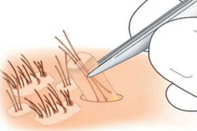 取毛囊照片 取毛囊照片