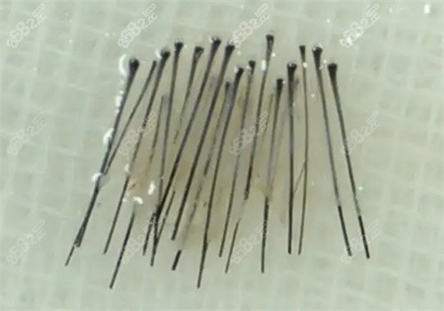 毛囊處理照片 毛囊處理照片