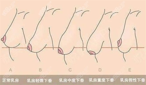 姚成红乳房提升技术优势