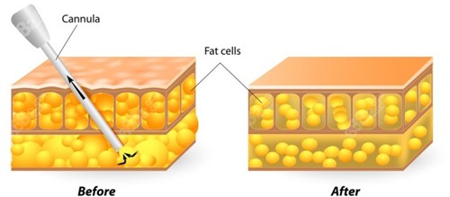 吸脂前后对比图示.jpg