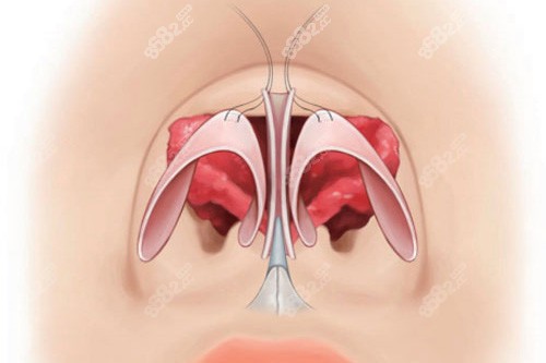 鼻整形缝合鼻小柱和鼻翼