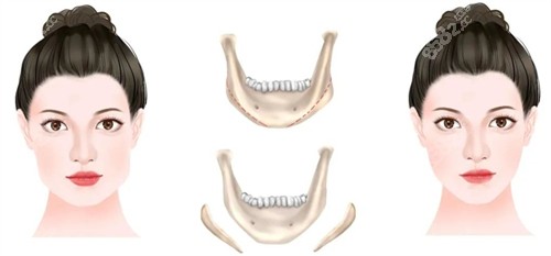 下颌角手术前后对比图和截取部分