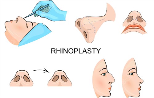 隆鼻过程图示.jpg