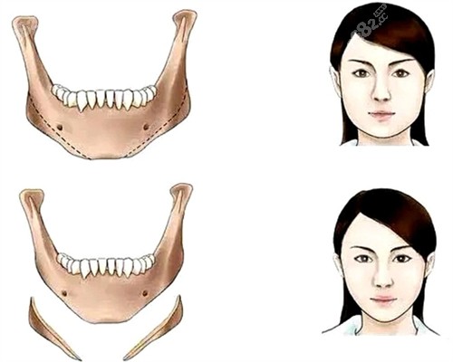 改善面部线条的下颌骨手术