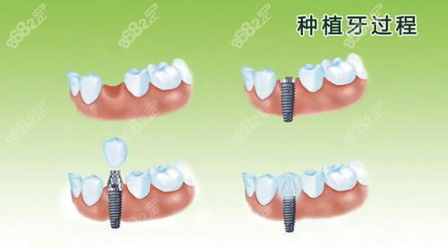 种植牙过程示意图