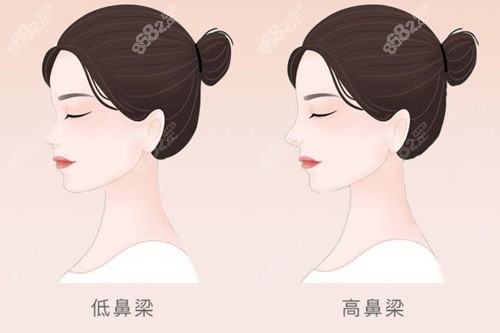 鼻部整形对比卡通图