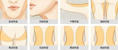 <!--<i data=20240705-sp></i>-->吸脂口碑好